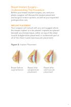 Sientra Silicone Gel Breast Implants - 11