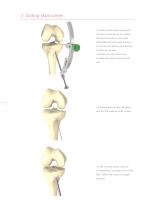 Inion® ACL Instrument Set-4