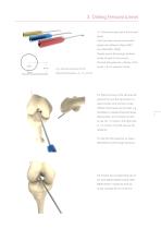 Inion® ACL Instrument Set-5