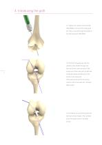 Inion® ACL Instrument Set-6