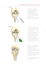 Inion® ACL Instrument Set-7