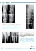 SAFE DualCore Universal Nail-6