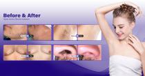 Perfectlaer Z890C Hair Removal Machine-14
