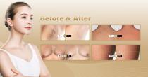 Perfectlaer Z890E Hair Removal Machine-15