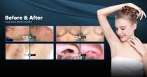 Perfectlaser Z890B Hair Removal Machine-13