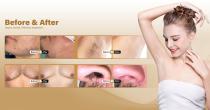 Perfectlaser Z890G Hair Removal Machine-13