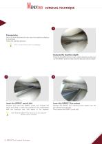 Surgical Technique - Meniscus Repair - MENIX® DUO-2
