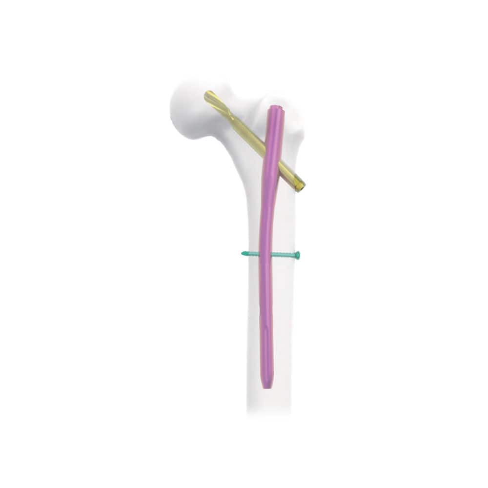 Haste intramedular para fêmur - NORMMED Medical Devices - para ...