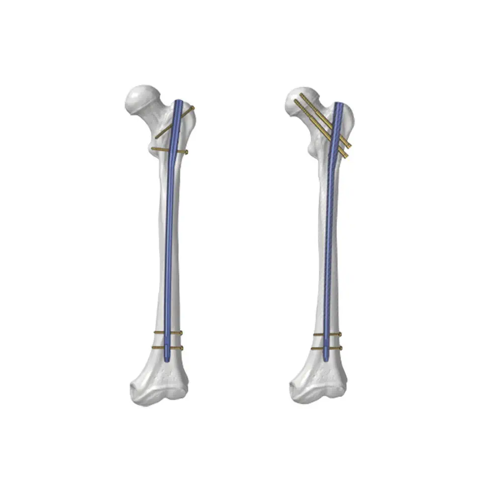 Haste intramedular para fêmur - KTO - Kangli Medical - fixação proximal /  fixação distal / em titânio, image size:1000x1000