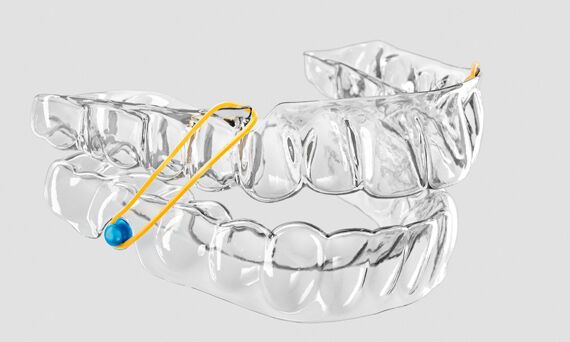 Aparelho miofuncional transparente - SureSmile® - Dentsply Sirona