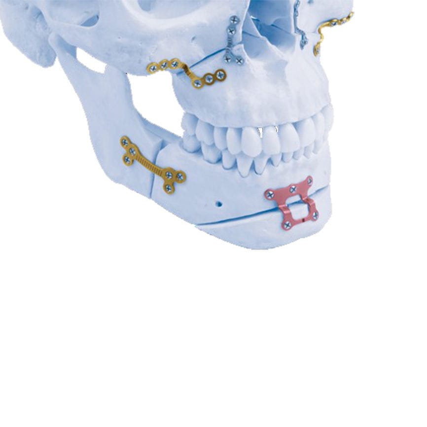 Placa de compressão óssea para mandíbula Matrix ORTHOGNATHIC™ Depuy