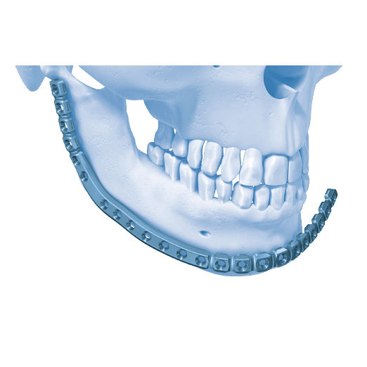 Placa de compressão óssea para mandíbula - MatrixORTHOGNATHIC