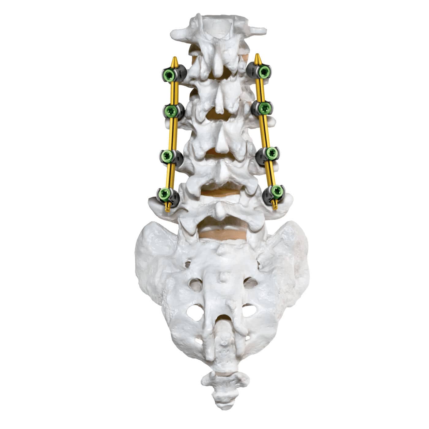 Percutaneous Bunionette Correction - Foot and Ankle Clinics, image size:1400x1400