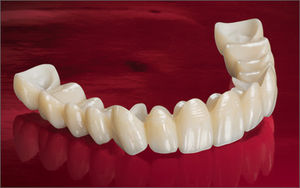 coroa dentária em zircônia