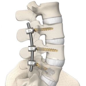 sistema de osteossíntese toracolombar