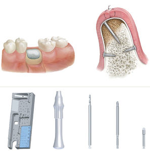 kit de instrumentos para cirurgia odontológica
