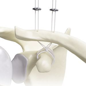 botão de sutura para reconstrução do ligamento acromioclavicular 1