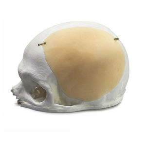 implante craniano sob medida