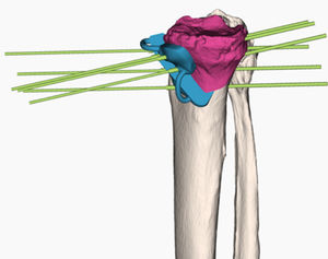 guia de ressecção para osteotomia tibial
