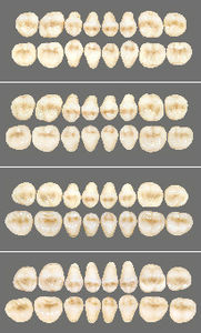 prótese dentária em acrílico 1