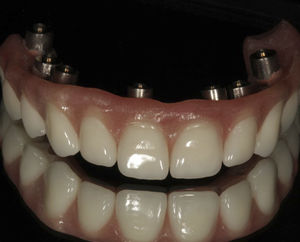 prótese dentária em acrílico 1