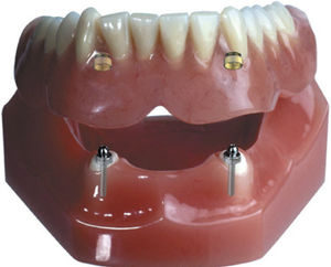 prótese dentária para dentes anteriores