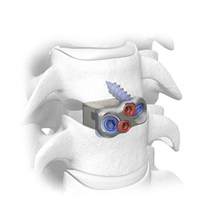 espaçador intervertebral cervical