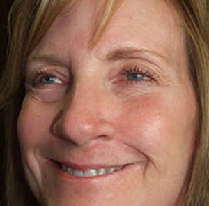 prótese estética nasal