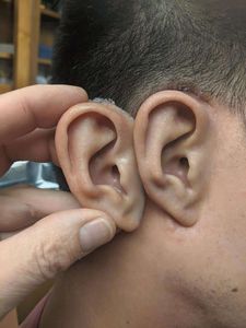 prótese estética auricular