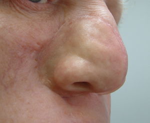 prótese estética nasal