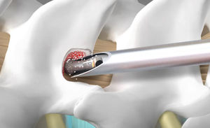 fresa para cirurgia da coluna vertebral