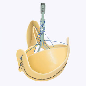 bioprótese valvar aórtica / de tecido bovino / sem stent