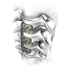 placa para artrodese cervical