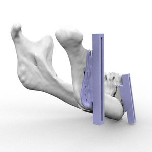 guia de ressecção para reconstrução maxilofacial 1