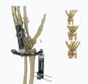 fixador externo para punho 1