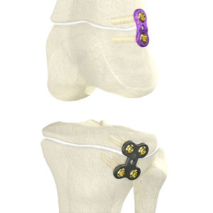 placa de osteotomia para fêmur
