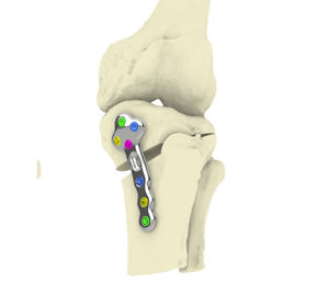 placa de osteotomia para tíbia