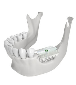 material dentário em titânio