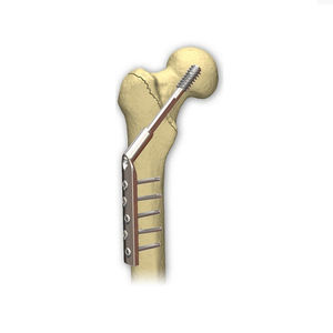 placa de compressão óssea para cabeça femoral