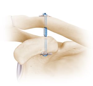 botão de sutura para reconstrução do ligamento acromioclavicular