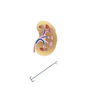 bainha de acesso ureteral