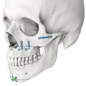 Placa de compressão óssea para mandíbula - MatrixORTHOGNATHIC