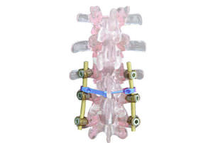 sistema de osteossíntese cervico-tóraco-lombo-sacral