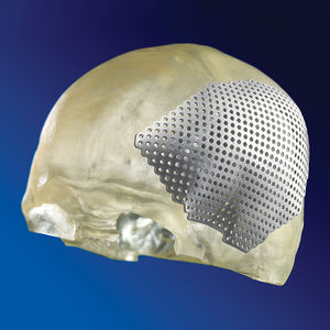 implante craniano