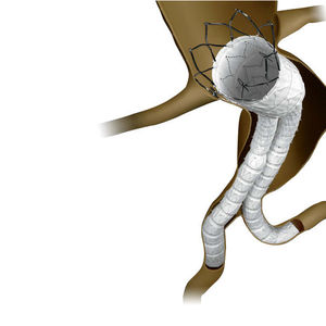 stent-enxerto de aorta abdominal