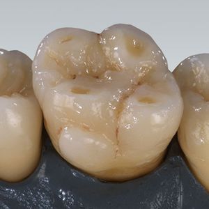 material dentário em zircônia