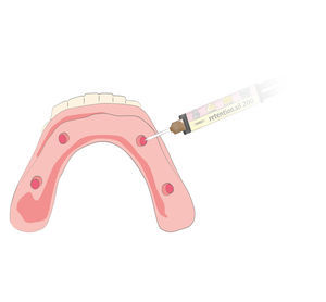 cimento odontológico para sistemas de implantes