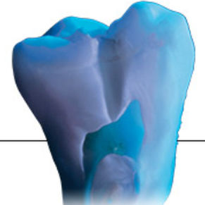 material dentário em cerâmica