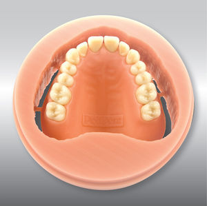 material dentário em PMMA 1