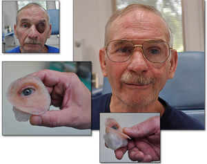 prótese estética hemifacial